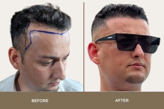 Hair Transplant in Pakistan