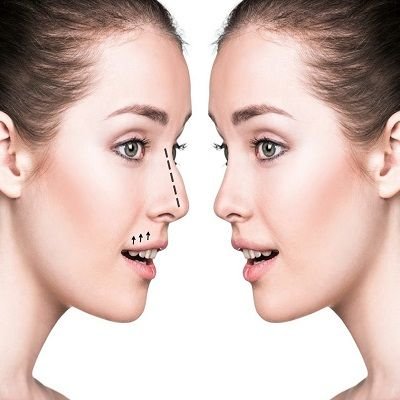Rhinoplasty in Islamabad