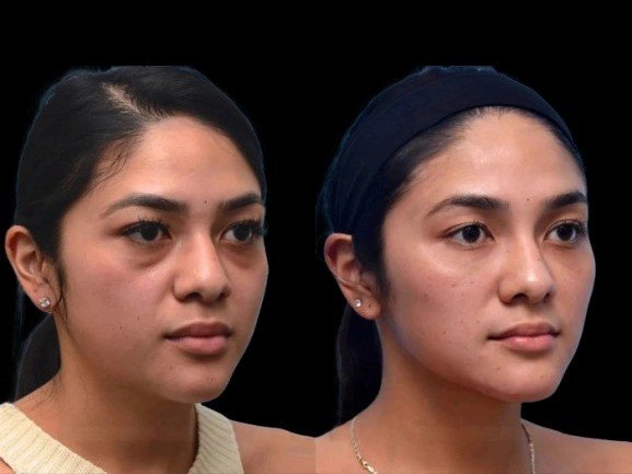 Post-Treatment Care Tips by the Best Doctors in Dubai for Dark Circles Treatment Dark Circles Treatment in Dubai