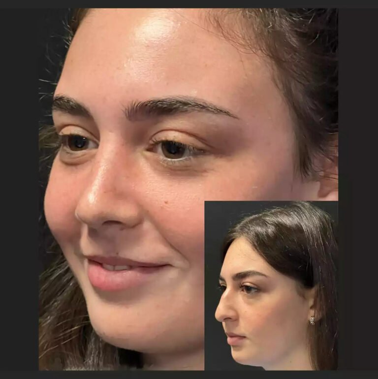 What Makes Best Doctors in Dubai Leaders in Rhinoplasty? Rhinoplasty in Dubai