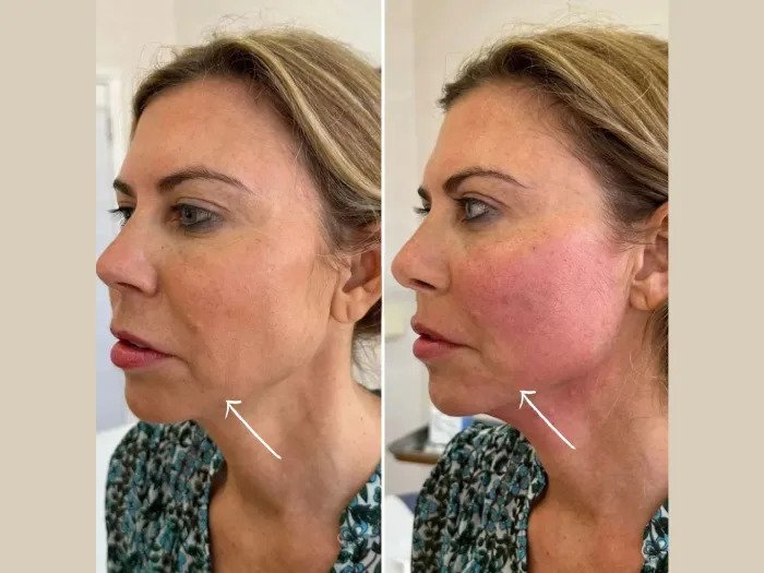 Endolift Laser Rejuvenation by Best Plastic Surgeons in dubai
