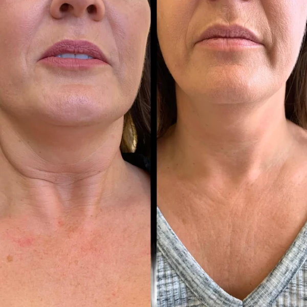 Profhilo Treatments in Dubai for Advanced Tissue Hydration Profhilo in Dubai