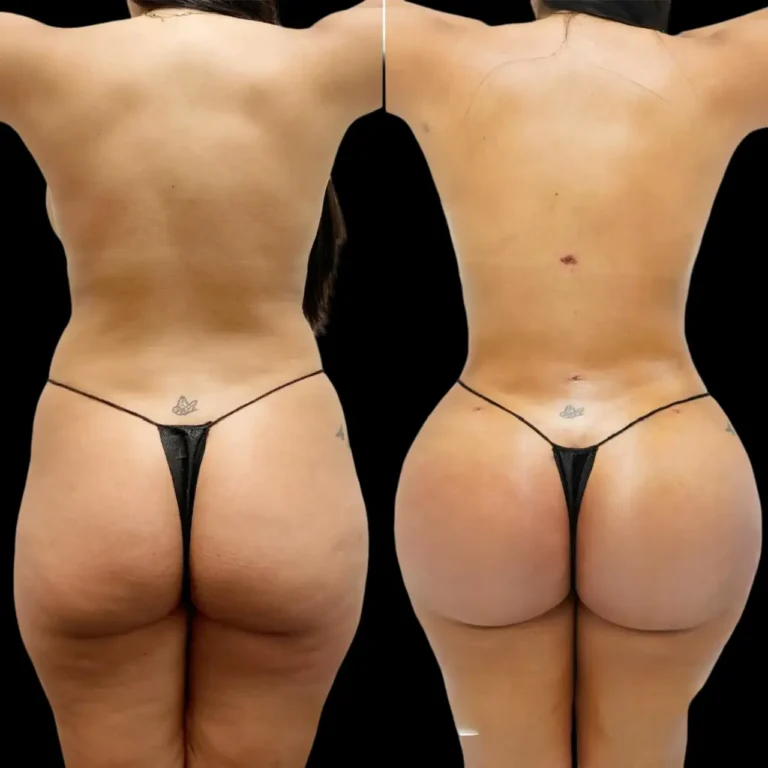 Best Butt Fat Transfer Surgeons in Dubai Using Advanced Fat Harvesting Techniques Butt Fat Transfer in Dubai