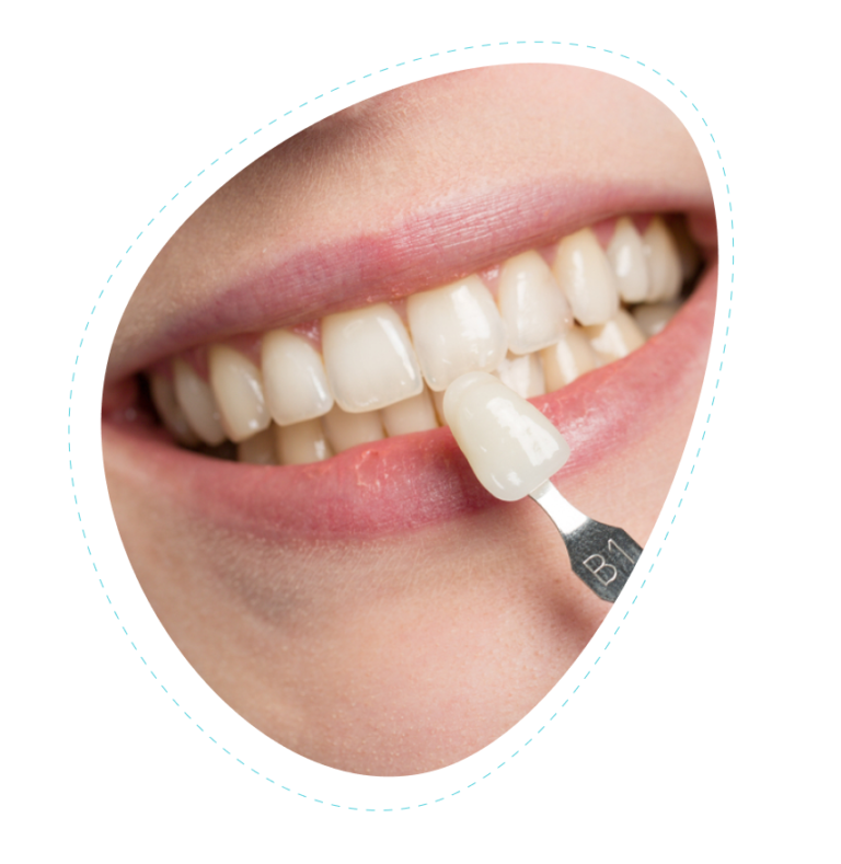 dental crowns in Floresville tx