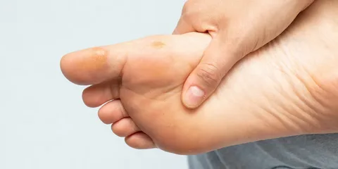 Why Foot Warts Spread Fast Edinburgh Clinic Advice