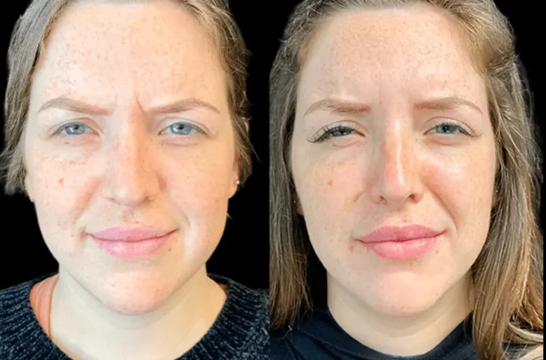 How Long Does Botox in Dubai Last? Maintenance Explained Botox in Dubai