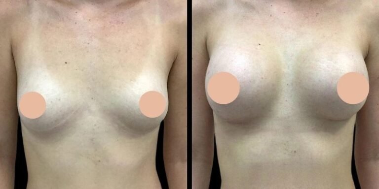 Breast augmentation in Dubai