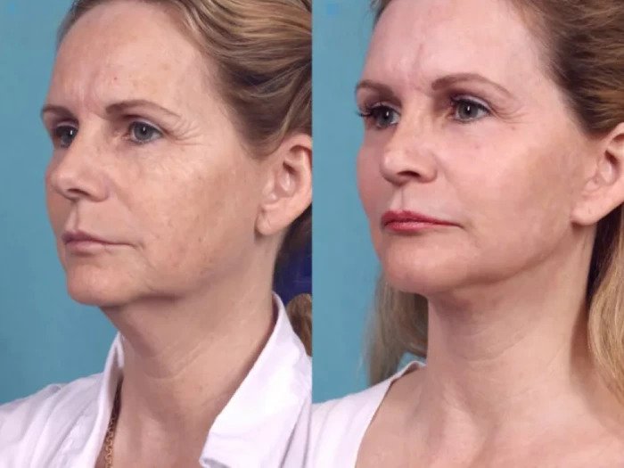 Best Doctors in dubai for Chemical Peel Skin Enhancement Chemical Peel in Dubai