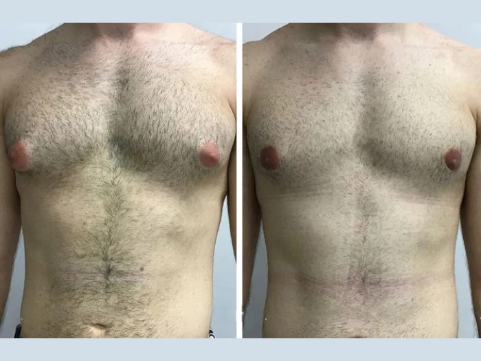Emotional Benefits of Choosing Gynecomastia Surgery in dubai Gynecomastia in Dubai