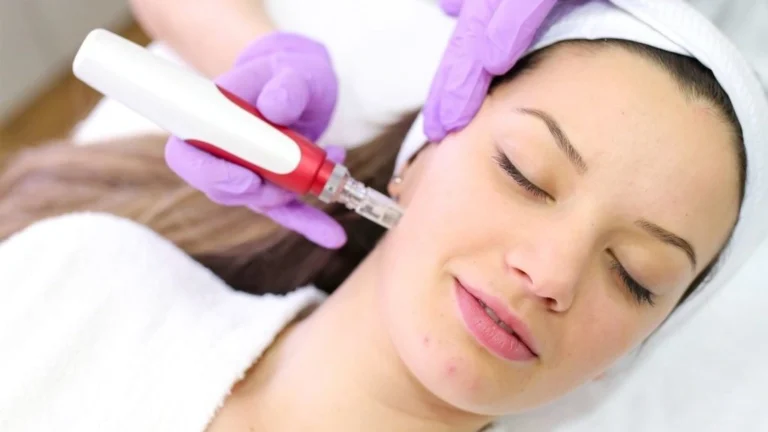 Microneedling in islamabad