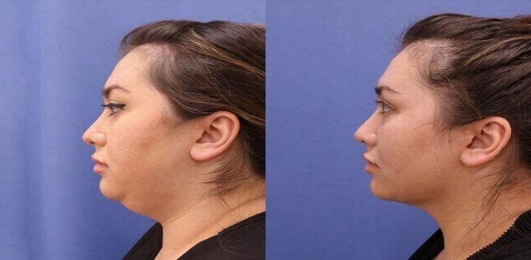 Expert Chin Lipo Treatment in Islamabad for Flawless Look