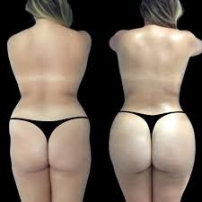 The Growing Popularity of Butt Fat transfer in Dubai butt fat transfer in dubai