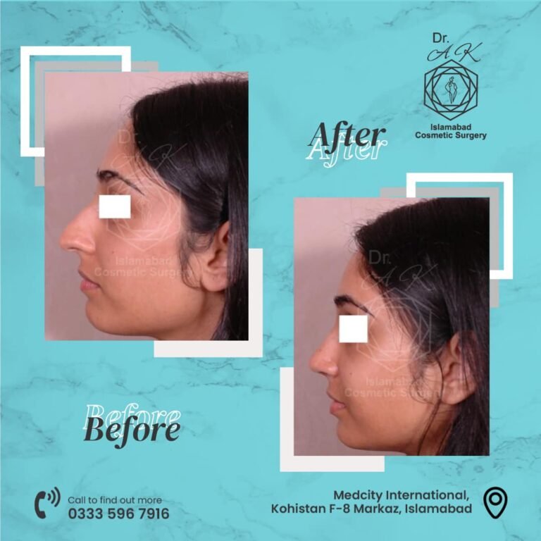 rhinoplasty in islamabad