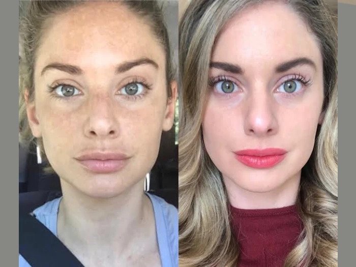 Best Plastic Surgeon in Dubai for Radiofrequency (RF) Microneedling in Dubai with Proven Results and Expert Care Radiofrequency (RF) Microneedling in Dubai