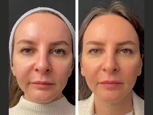 Mesotherapy Treatment in Dubai: Quick Treatments for Busy Lifestyles