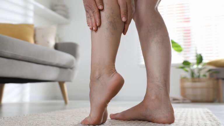 Effective Spider Veins Treatment in Manchester for Smooth, Clear and Healthy-Looking Legs Spider Veins In Manchester