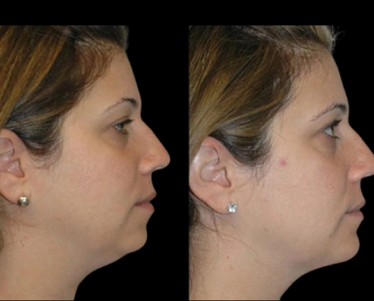 Treatment Suitability Factors from the Best Double chin removal Surgeons in dubai Double chin removal in Dubai