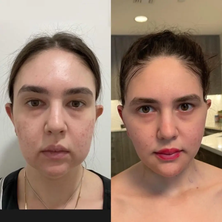 Best Buccal Fat Removal Surgeons in Dubai: How It Works Buccal Fat Removal in Dubai