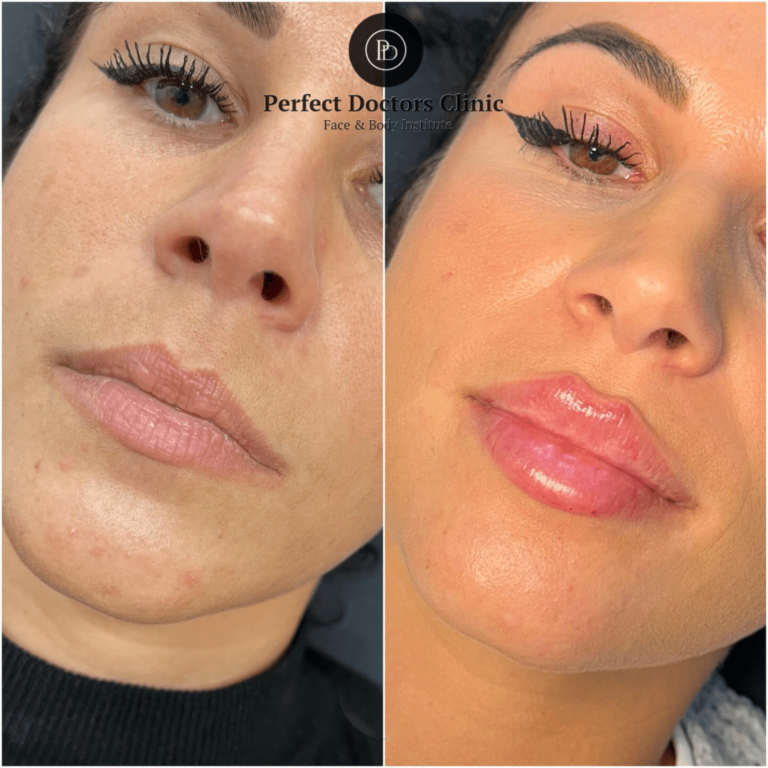 Under-Eye Filler Solutions with Juvederm from the Best Doctors in dubai Juvederm in Dubai
