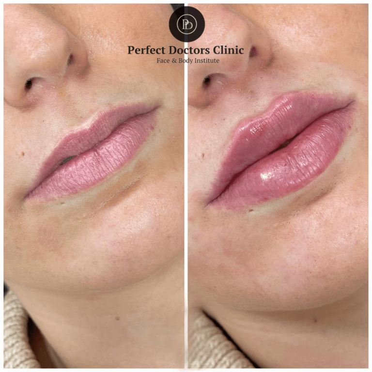 Mid-Face Volume Restoration Using Juvederm by the Best Doctors in dubai Juvederm in Dubai
