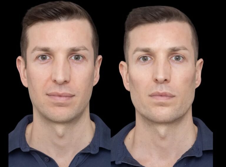Cheek Fillers The Best Doctors in Dubai Share Their Expert Advice cheek fillers