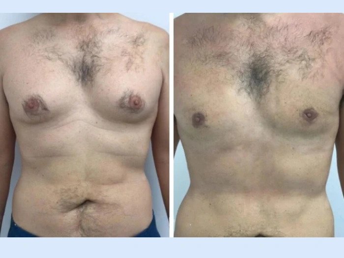 Comparing Results from the Best Gynecomastia Surgeon in Dubai Clinics Gynecomastia in Dubai