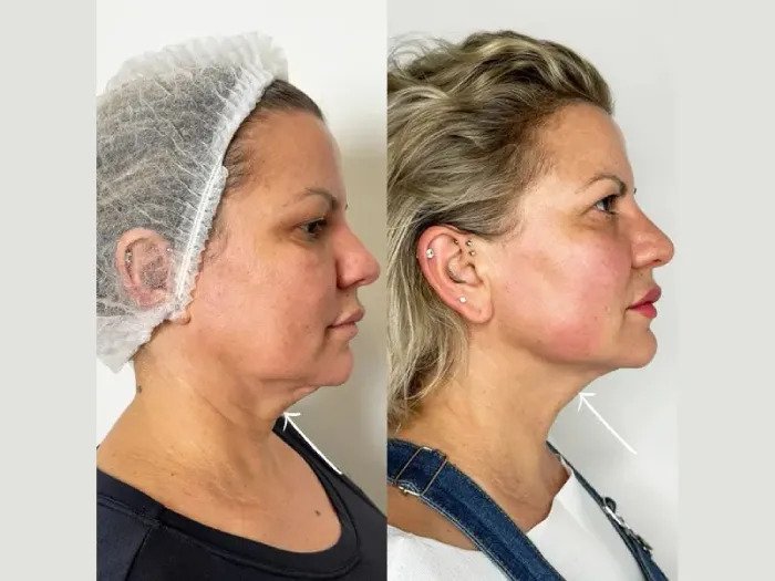 Best Doctors in dubai Delivering Precision Endolift for Facial Enhancement Best Doctors in dubai Delivering Precision Endolift for Facial Enhancement