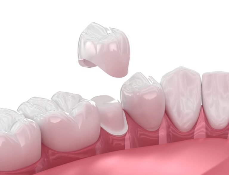 Caring for Your Dental Crown Dubai for Long-Term Success