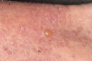 The Best Ways to Treat Bullous Pemphigoid with Natural Remedies The Best Ways to Treat Bullous Pemphigoid with Natural Remedies