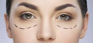 Lower Blepharoplasty in London: Treatment for Under-Eye Bags Explained