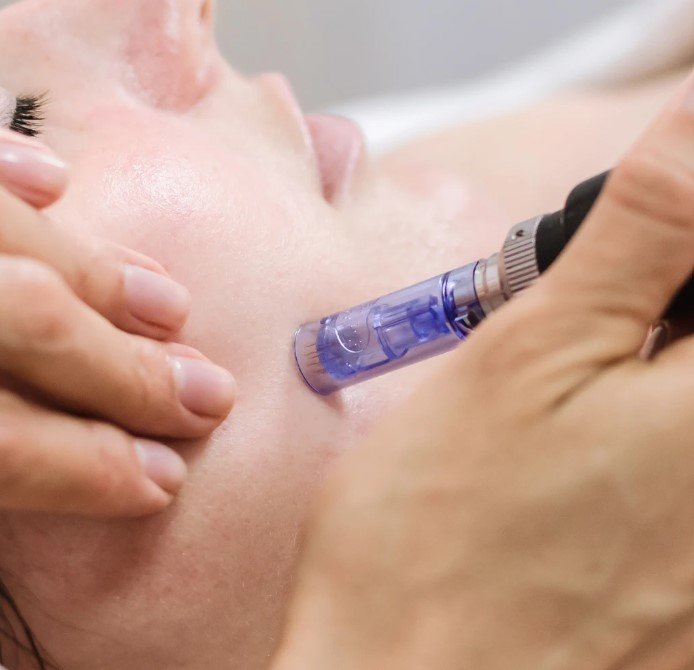Microneedling In Manchester – Renew and Revitalize Your Skin Microneedling In Manchester