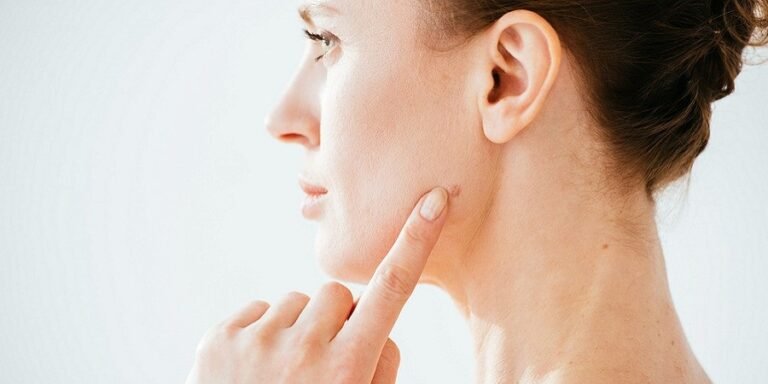 mole removal in islamabad pakistan